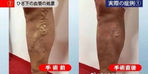 【大发体育】东京血管外科定制super glue治疗方式，成功为张琳芃治愈静脉曲张，大发助力你的致富之路！